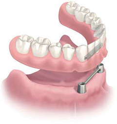 ドルダーバー固定式義歯