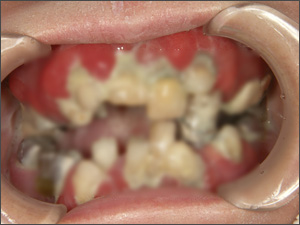 フルフィックス治療前重度歯周病