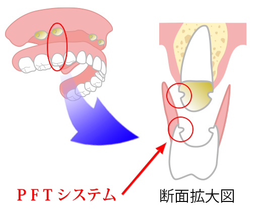 PFT固定システム入れ歯