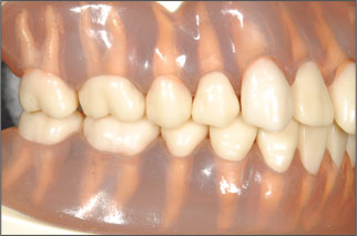 歯の模型１