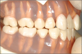 歯の模型２